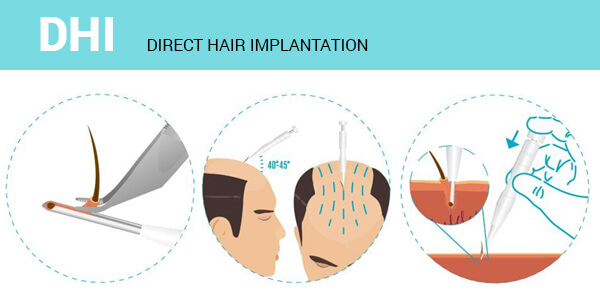 DHI - DIRECT HAIR IMPLANTATION
