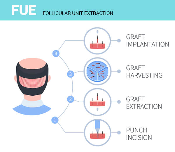 FUE - FOLLICULAR UNIT EXTRACTION